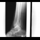 Trimalleolar fracture, subluxation in talocrural joint: X-ray - Plain radiograph